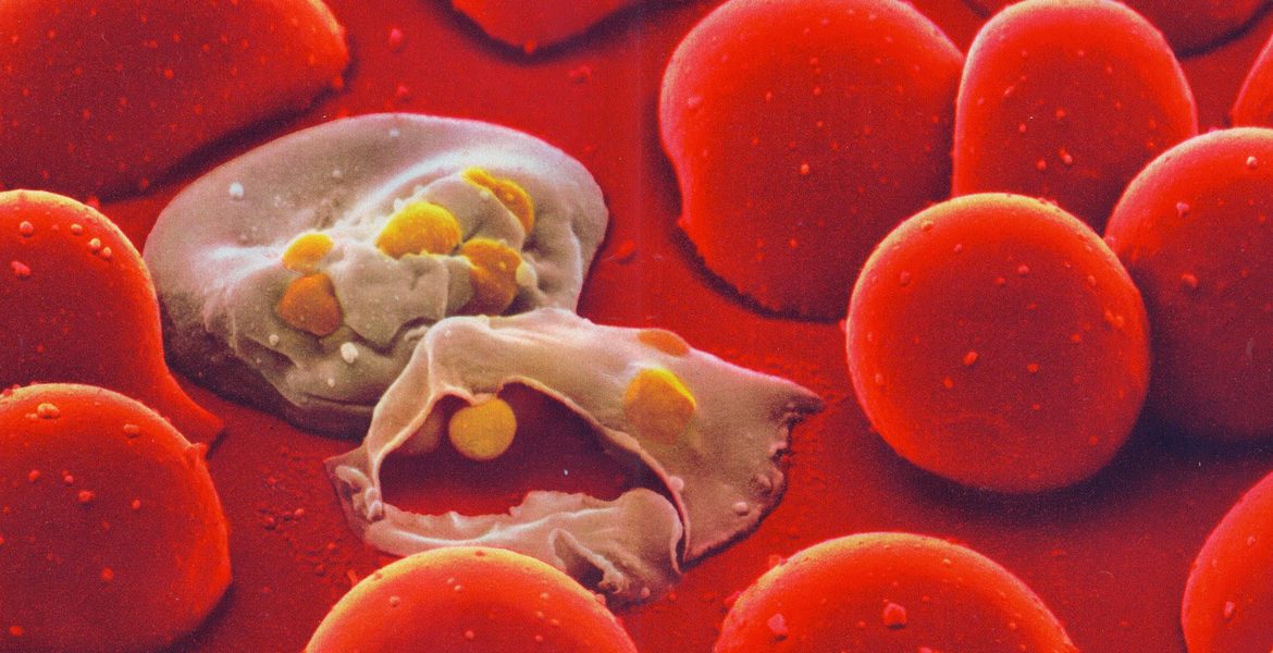 LA MALARIA MATA A UN NIÑO CADA MINUTO
