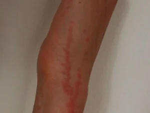 Picaduras reales de chinche alineadas en hilera sobre un brazo