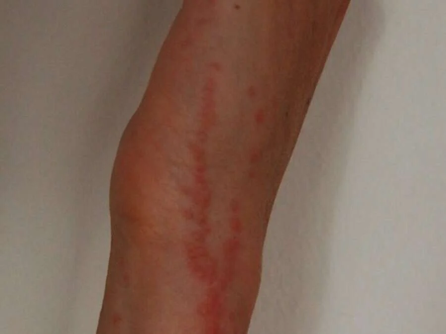 Picaduras reales de chinche alineadas en hilera sobre un brazo